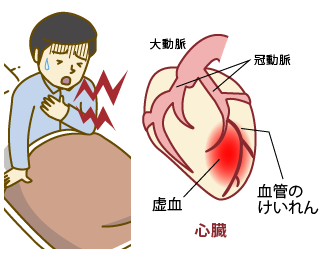 安静時狭心症のイラスト