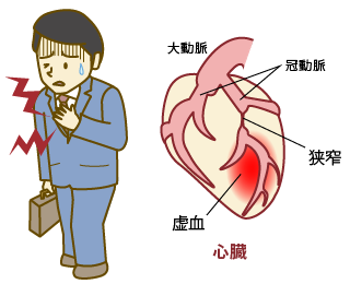 労作性狭心症のイラスト
